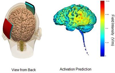 Maximizing the Treatment Benefit of tDCS in Neurodegenerative Anomia